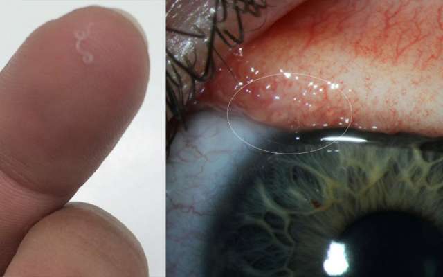 Abby Beckley, de 26 años, es el primer caso humano conocido de una infección parasitaria propagada por moscas; estos gusanos afectan ojos del ganado