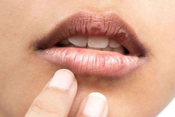 La enfermedad es un efecto secundario poco común de algunos antibióticos. Foto: Especial