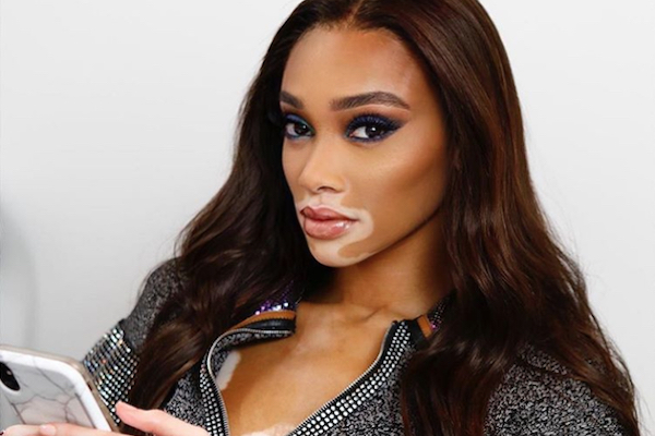 enfermedad de vitiligo