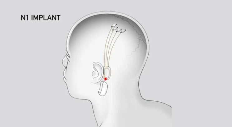 Neuralink N1