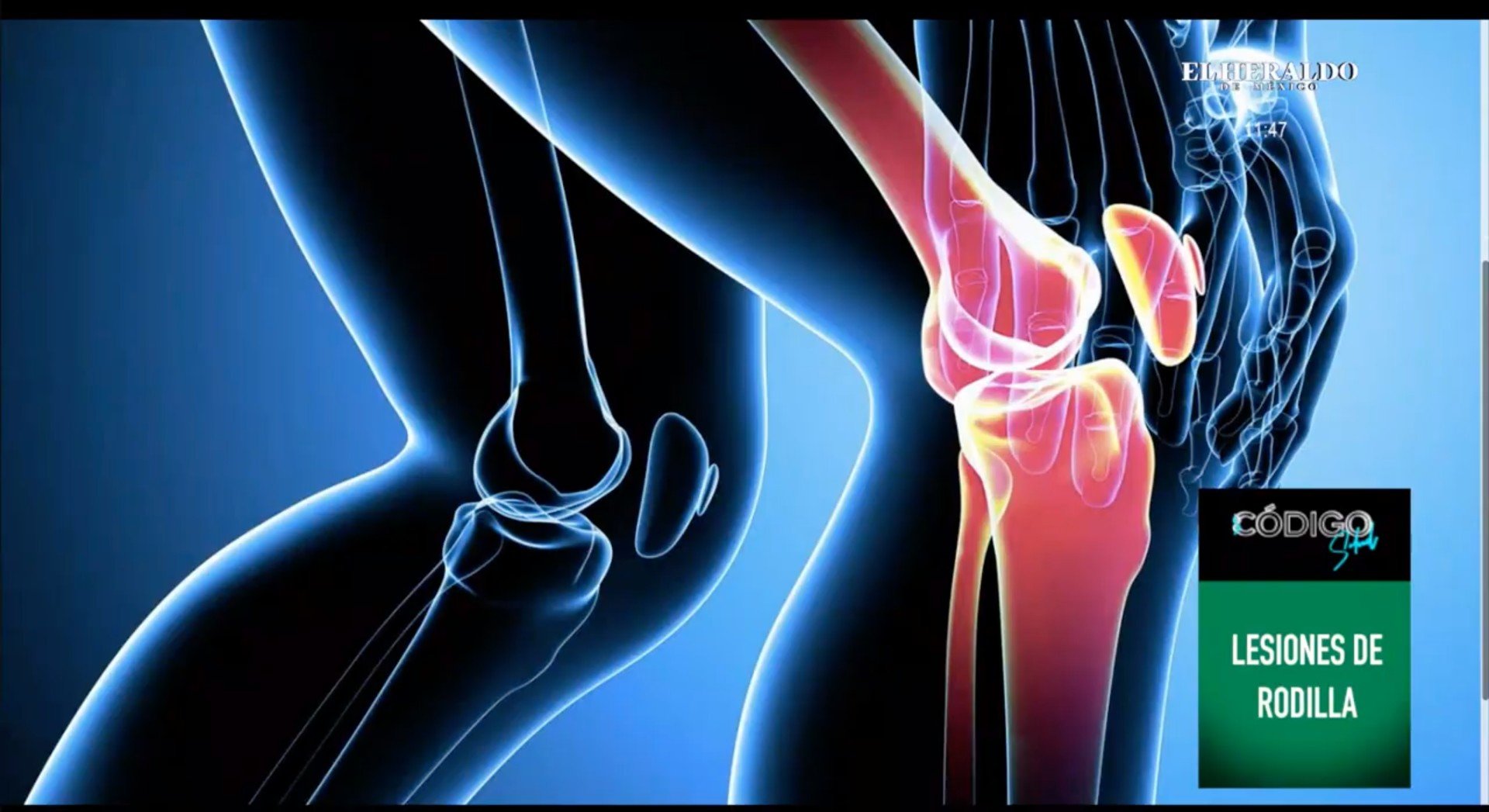 Tipos de lesiones de rodilla