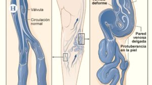 Riesgos y peligros que provocan las várices