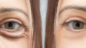 Blefaroplastia