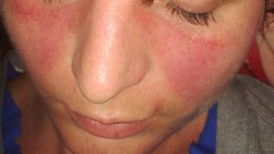 Lupus
